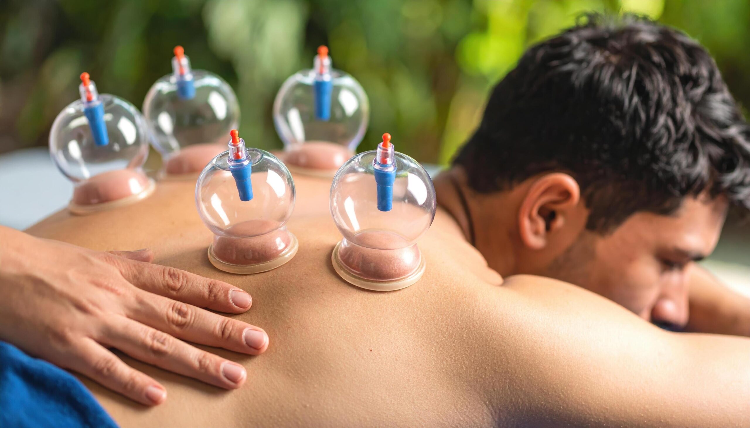 Jurupa Valley, CA — Why Are Athletes Choosing Cupping for Recovery? - Recovery Lab of Corona